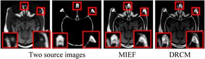 DRCM: a disentangled representation network based on coordinate and multimodal attention for medical image fusion